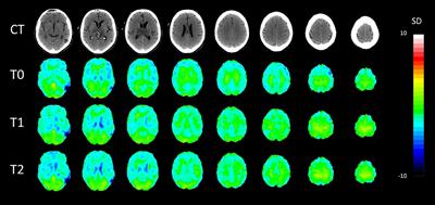 A Multimodal Imaging Study in a Case of Bilateral Thalamic Damage With Multidomain Cognitive Impairment